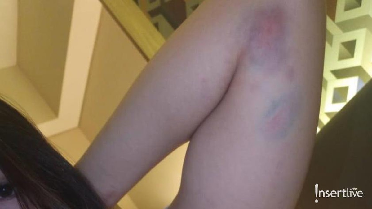 Foto Bukti KDRT Aska Ongi