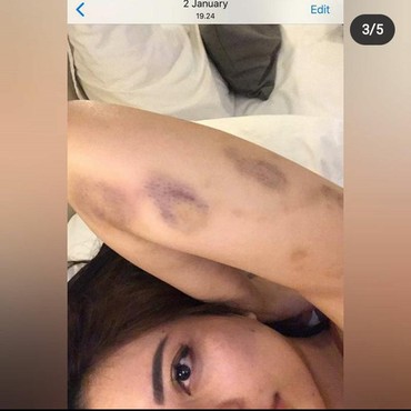 Babak Belur Dipukuli Suami Saat Hamil, Ini Pengakuan Lengkap Aska Ongi