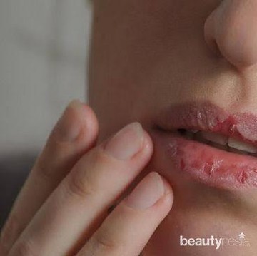 6 Cara Atasi Bibir Kering dan Pecah-pecah Selama Puasa