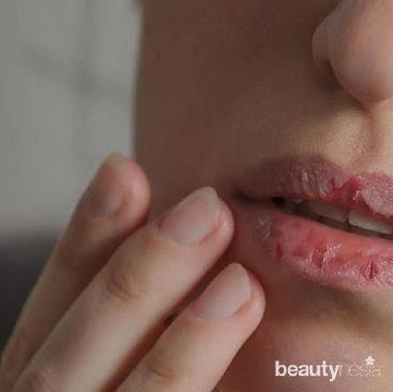 img-title 6 Cara Atasi Bibir Kering dan Pecah-pecah Selama Puasa