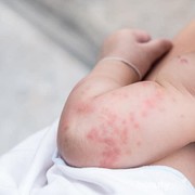 Langkah-Langkah Mengatasi dan Mencegah Ruam Pada Kulit Bayi