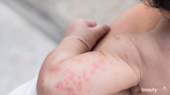 Langkah-Langkah Mengatasi dan Mencegah Ruam Pada Kulit Bayi