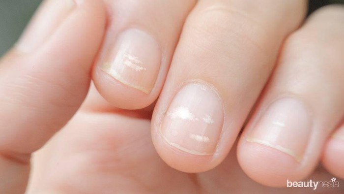 Bukan Cuma Mitos, Garis Pada Kuku Ternyata Jadi Petunjuk Kondisi Kesehatan Tubuhmu!