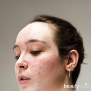 Awas, Ternyata 5 Makanan Ini Bisa Memicu Jerawat!