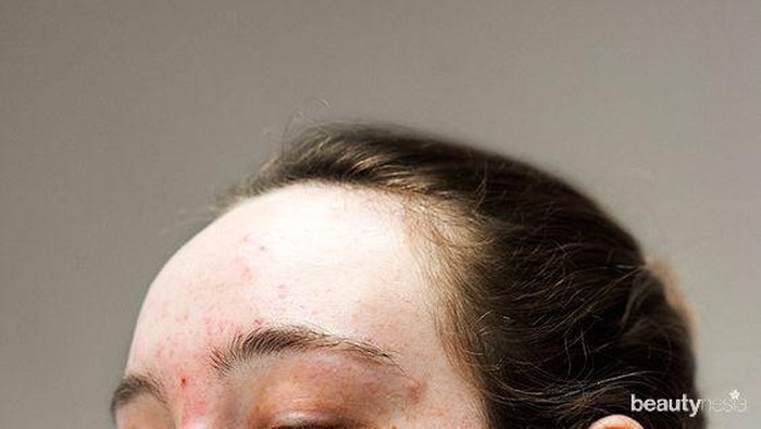 Awas, Ternyata 5 Makanan Ini Bisa Memicu Jerawat!