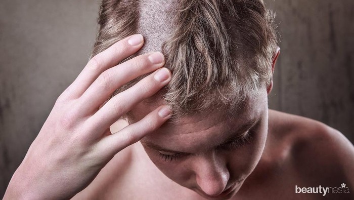 Salah Cukur Sampai Jadi Pitak? Begini Cara Mengatasinya