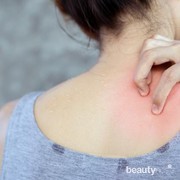 Ampuh Mengatasi Gatal, 5 Rekomendasi Bedak Gatal