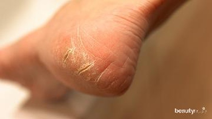 Tumit Pecah-Pecah Bikin Gak PD? Simak Tips Merawat Tumit Agar Halus dan Lembut Ini!