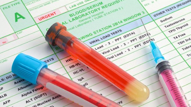 Golongan darah tertentu ternyata berisiko lebih tinggi mengalami stroke di usia muda. Lantas, apa golongan darah rentan stroke?
