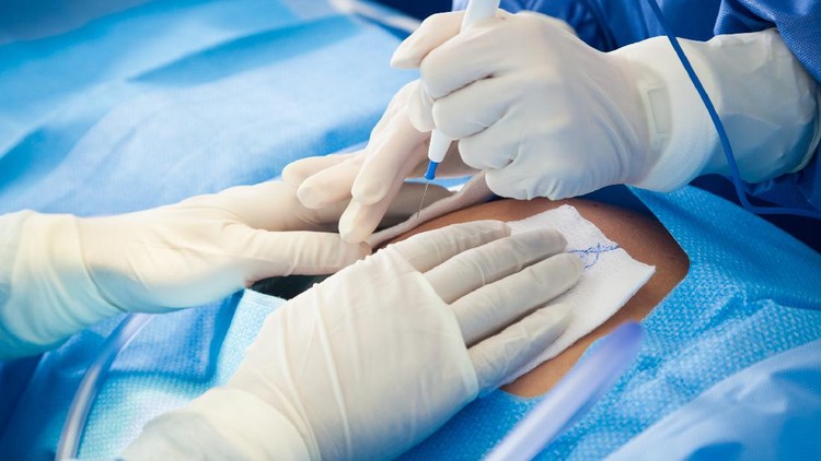 caesar Surgeons preparing patient for C-Section surgical procedure in hospital