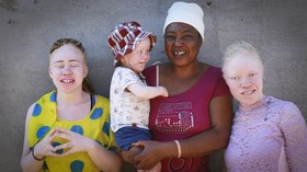 FOTO: Kala Kaum Albino Zimbabwe Mencari Kesetaraan