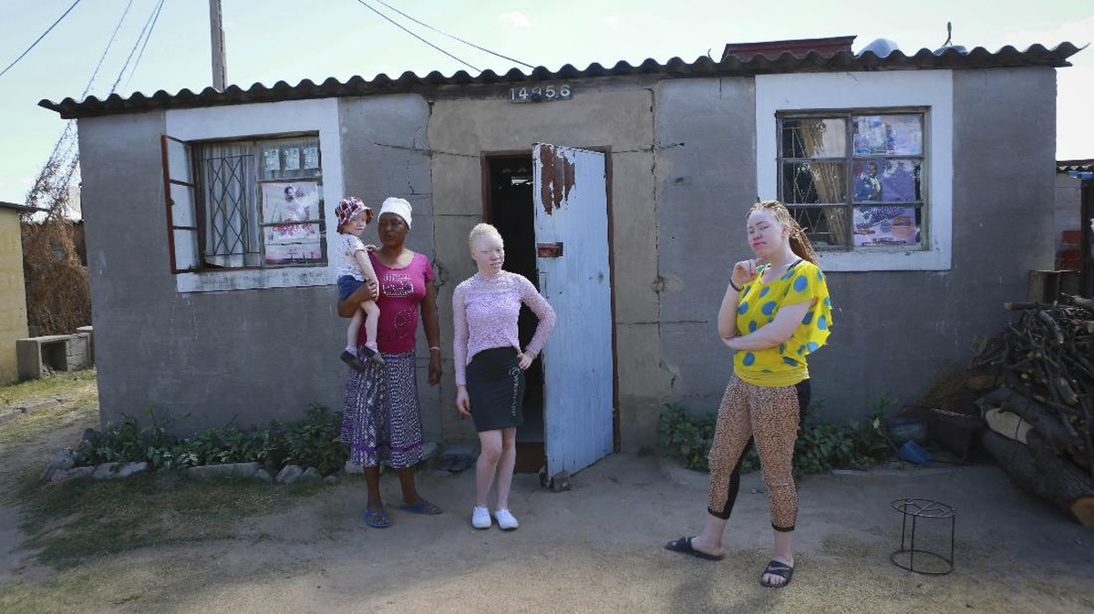 FOTO: Kala Kaum Albino Zimbabwe Mencari Kesetaraan