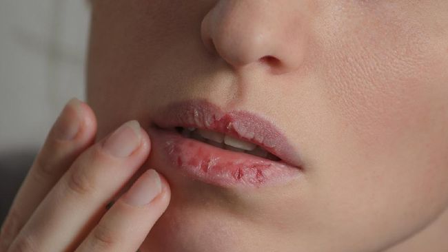 Dermatillomania skin picking. Woman has bad habit to pick her lips. Harmful addiction based on anxiety stress and dry lips. Excoriation disorder. Sick cracked damaged tissue.