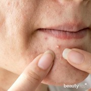 Cara Mengatasi Iritasi dan Jerawat karena Menggunakan Masker Selama Pandemi