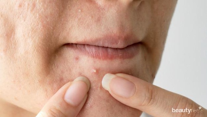 Cara Mengatasi Iritasi dan Jerawat karena Menggunakan Masker Selama Pandemi