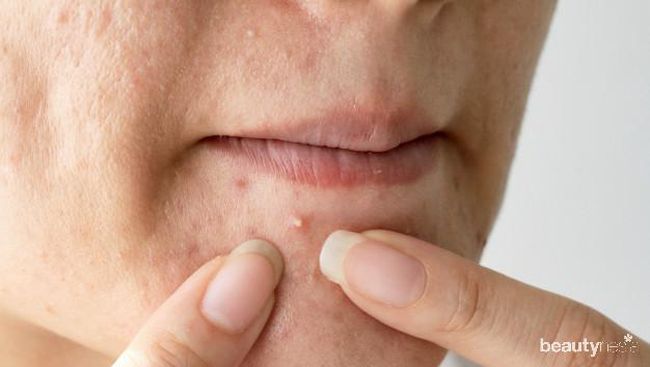 Cara Mengatasi Iritasi dan Jerawat karena Menggunakan  