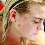 Gak Melulu Skincare, Kebiasaan ini Bisa Jadi Penyebab Jerawat Parah