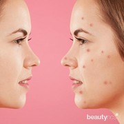 Perbedaan Cara Mengobati Bekas Jerawat Hitam dan Merah