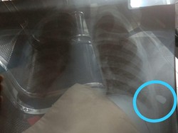 Ini Penampakan Peluru yang Bersarang di Punggung Bocah Korban Peluru Nyasar