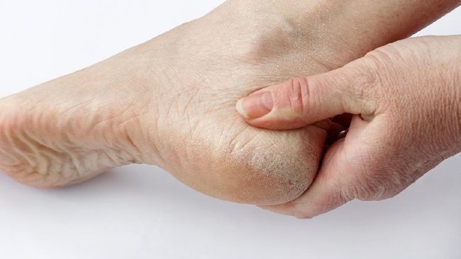 A woman has dry skin and calluses on the feet