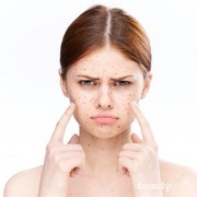 Ciri-ciri Fungal Acne dan Cara Ampuh Mengatasinya