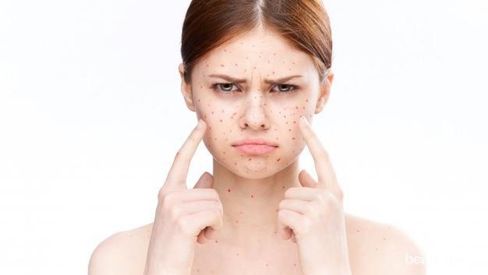 Ciri-ciri Fungal Acne dan Cara Ampuh Mengatasinya Ciri-ciri Fungal Acne dan Cara Ampuh Mengatasinya