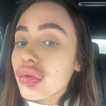 Perawatan Filler Gagal, Bibir Wanita Ini Disebut Mirip Bokong Monyet
