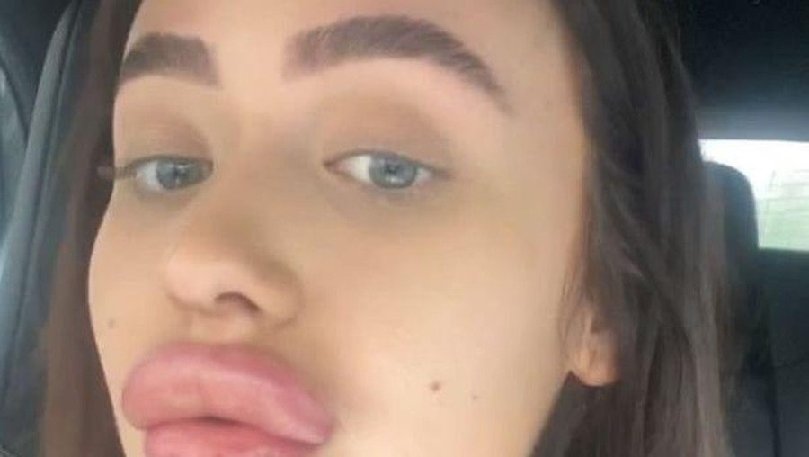 Pramugari yang gagal filler bibir.