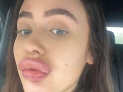 Perawatan Filler Gagal, Bibir Wanita Ini Disebut Mirip Bokong Monyet