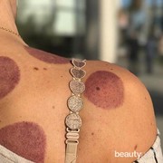 Pernah Coba Bekam? Ini 8 Manfaatnya