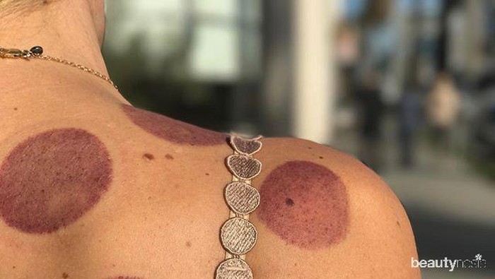 Pernah Coba Bekam? Ini 8 Manfaatnya