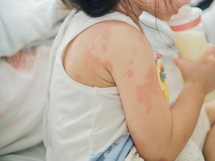 Yuk Intip Manfaat Probiotik buat Anak yang Alergi Susu Sapi, Bun!