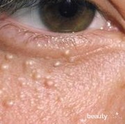 Begini Cara Menghilangkan Bintil-Bintil Putih Menganggu di Wajah