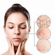 5 Cara Jitu Atasi Jerawat Batu