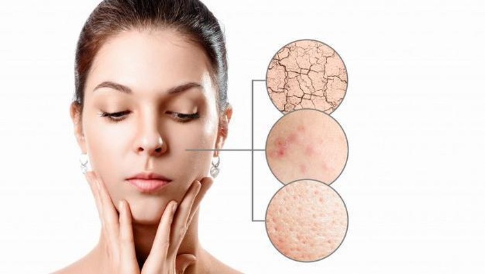 5 Cara Jitu Atasi Jerawat Batu