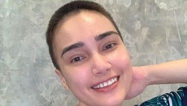 Rambut Rontok karena Kemoterapi, Feby Febiola: Cewek Botak Itu Keren