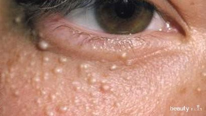 Hilangkan Milia di Wajahmu dengan Kiat-Kiat Berikut Ini!