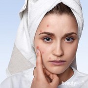 Cara Mudah Menutupi Jerawat Tanpa Concealer