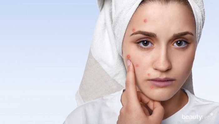 Cara Mudah Menutupi Jerawat Tanpa Concealer Cara Mudah Menutupi Jerawat Tanpa Concealer