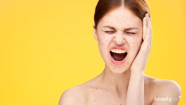 Cara Mengatasi Bekas Jerawat Kemerahan