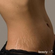 5 Bahan Alami untuk Menghilangkan Strechmark di Kulit