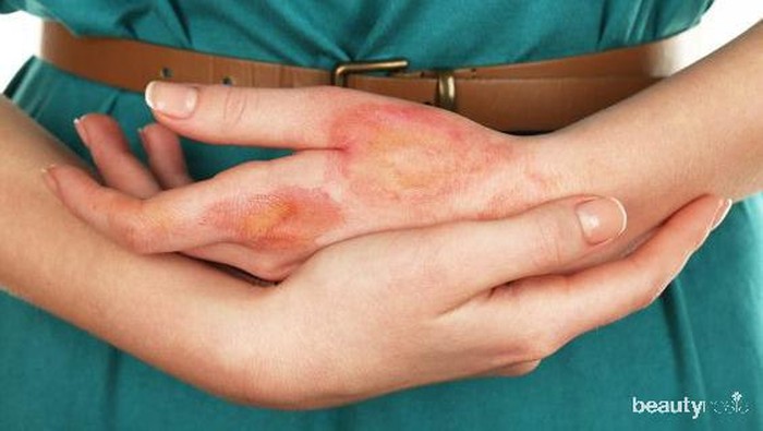 Gejala dan Cara Mengatasi Eksim di Kulit