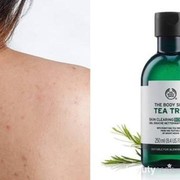 Basmi Jerawat di Punggung dengan Produk Sabun Mandi Ini