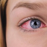 Mau Pakai Softlens? Ini Hal yang Perlu Dilakukan Agar Tidak Iritasi