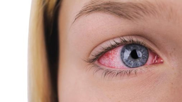 Mau Pakai Softlens? Ini Hal yang Perlu Dilakukan Agar Tidak Iritasi