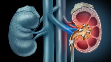 RSUP Dr Sardjito menyatakan belum menemukan bukti senyawa kimia pembentuk kristal menjadi pemicu gagal ginjal akut pada anak.
