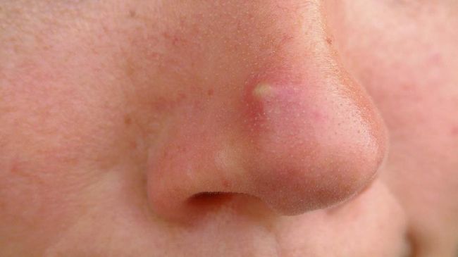 Punya jerawat memang menyebalkan. Selain menyebalkan, jerawat di wajah juga bisa merusak penampilan Anda, apalagi kalau jerawatnya muncul di hidung.