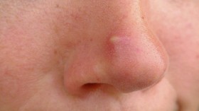 3 Alasan Jerawat Muncul di Hidung