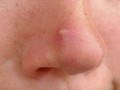 3 Alasan Jerawat Muncul di Hidung