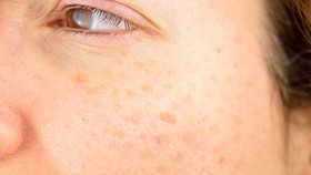 Tips GrabHealth untuk Hilangkan Flek Hitam secara Aman